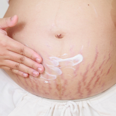 Heal Your Stretch Marks by Color