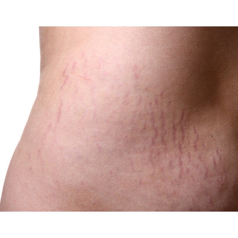 How to get rid of pregnancy stretch marks