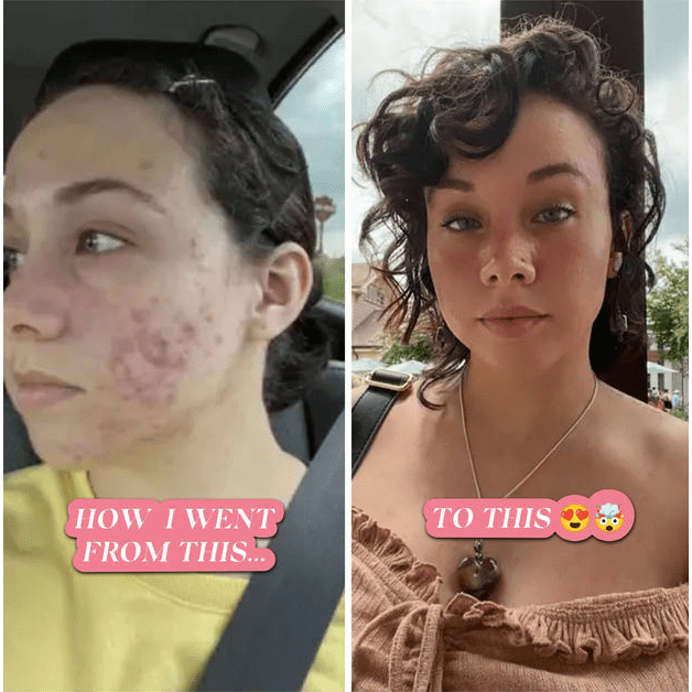BEFORE AND AFTER ACNE TREATMENT