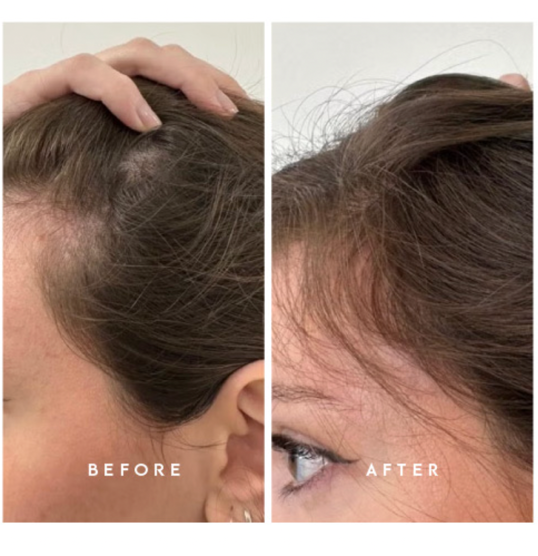Before and after comparison showing improved appearance of thinning hair along the hairline after using Hair She Is botanical hair serum.