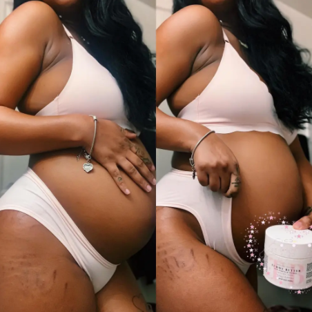 Daily routine to avoid stretch marks during pregnancy for 2021 Summer