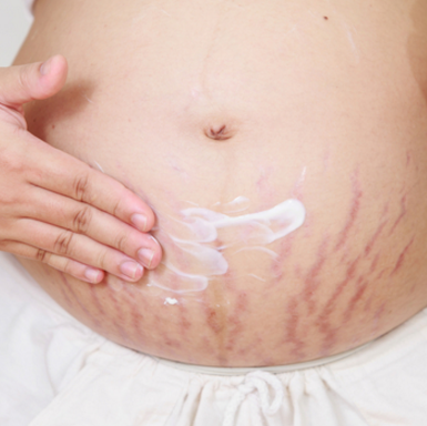 purple pregnancy stretch marks, stretch mark removal, pregnancy stretch marks | The Spoiled Mama, pregnancy skin care