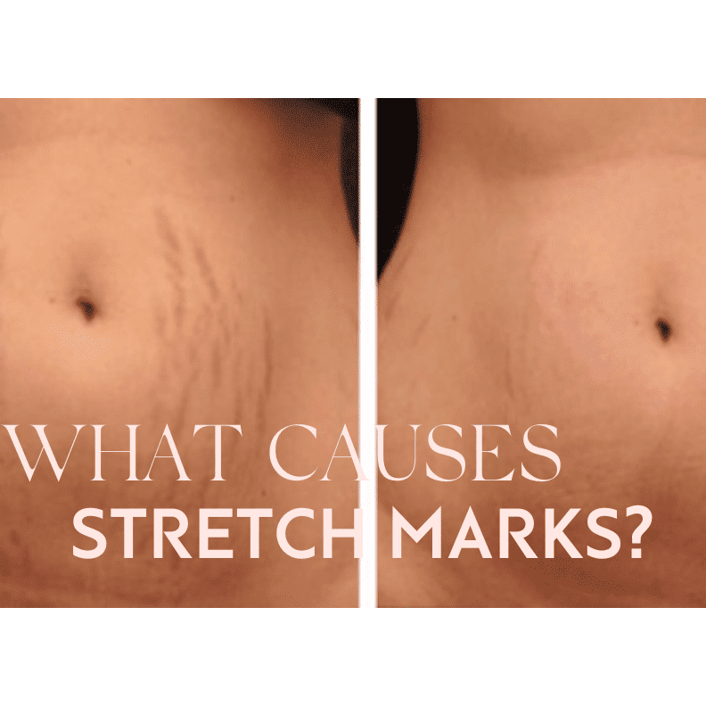 What Causes Pregnancy Stretch Marks?