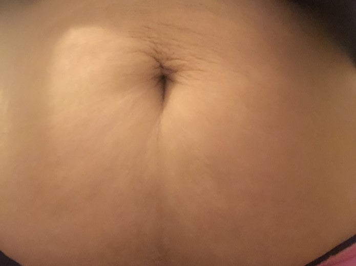 After consistent use of The Spoiled Mama Tummy Butter, showing smoother, more hydrated skin and improvement in the appearance of pregnancy stretch marks.