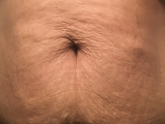 Before using The Spoiled Mama Tummy Butter, showing visible pregnancy stretch marks and dry, stretching skin on the abdomen.