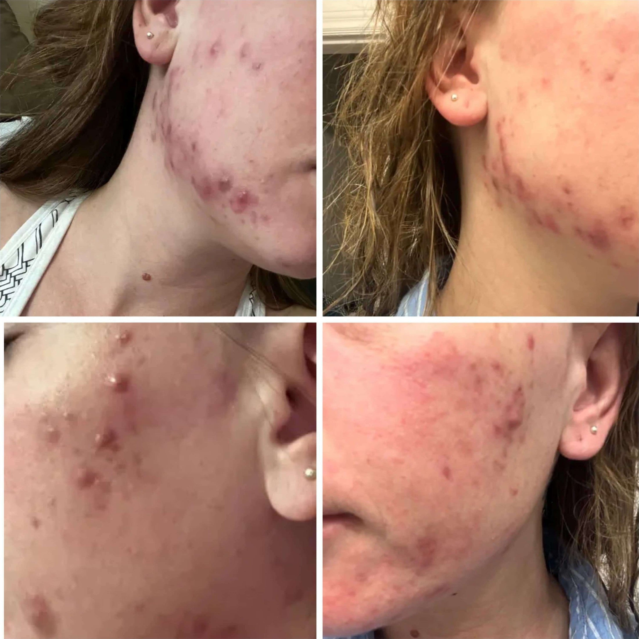 pimples on cheeks pregnancy