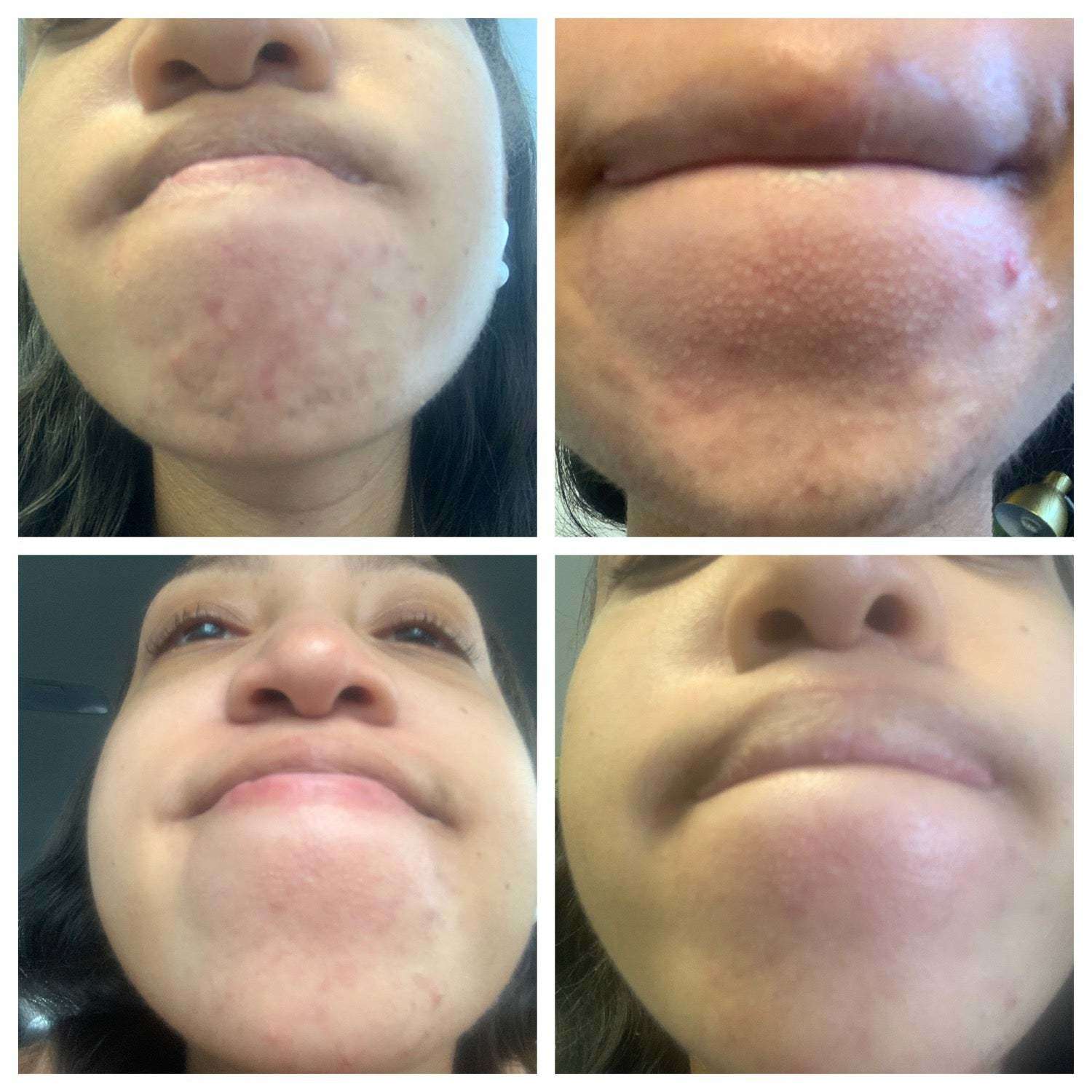 pregnancy and pimples on chin